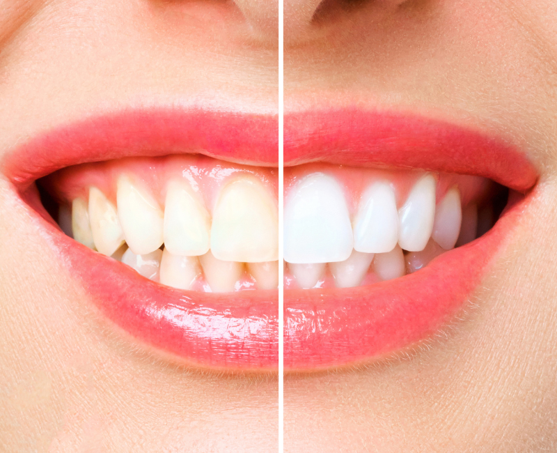 Unveiling the Process and Benefits of Teeth Whitening