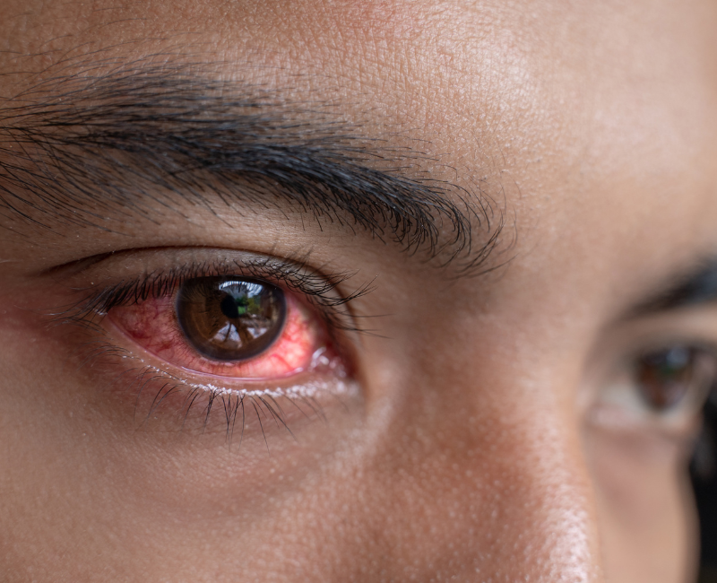 Pink Eye