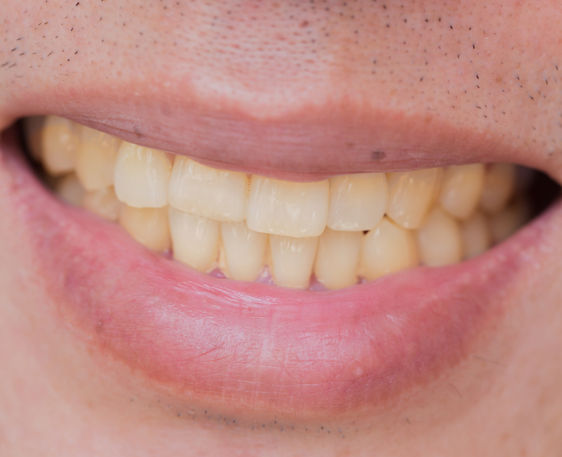Brown stains on teeth: Why it’s important to see a dentist near you