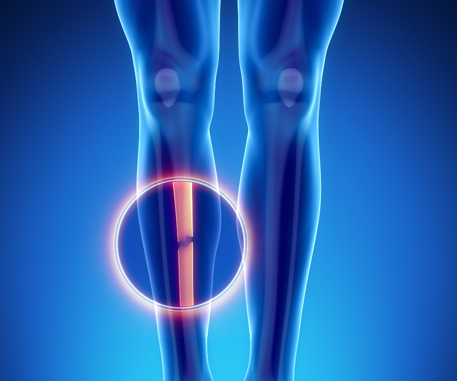 Demystifying Fractures and Hairlines on Bones