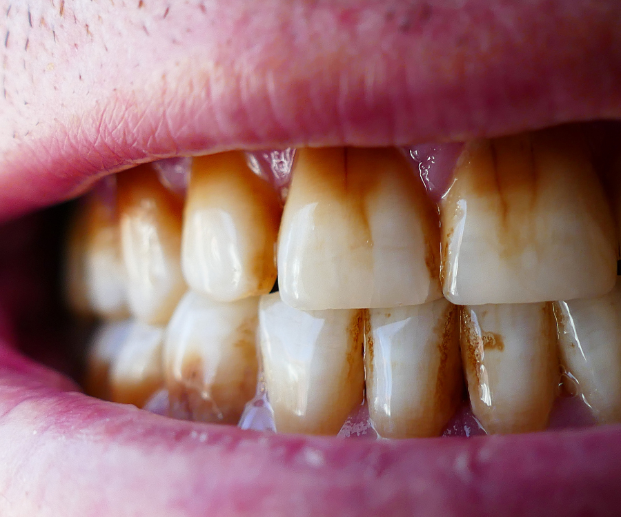 Tooth Discoloration