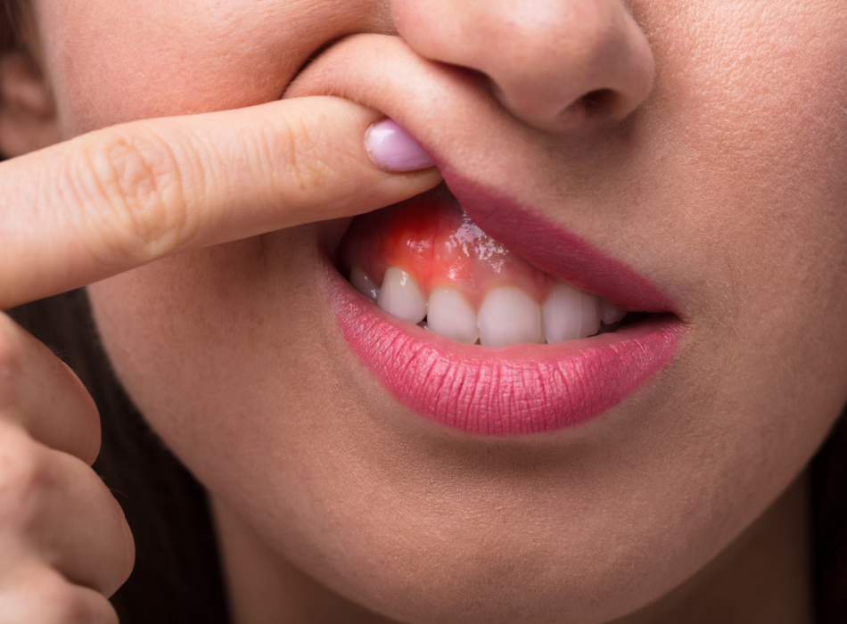 Let’s Talk About Gingivitis